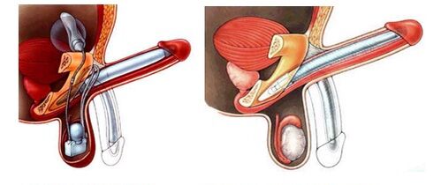 Penisprothese mit aufblasbarer (links) und Kunststoffprothese (rechts). 