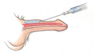 Volumengebende Injektion von Hyaluronsäure in den Penis